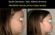 Denti sporgenti 1