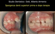 Denti sporgenti 2